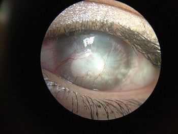 Corneal neovascularization and Corneal edema
