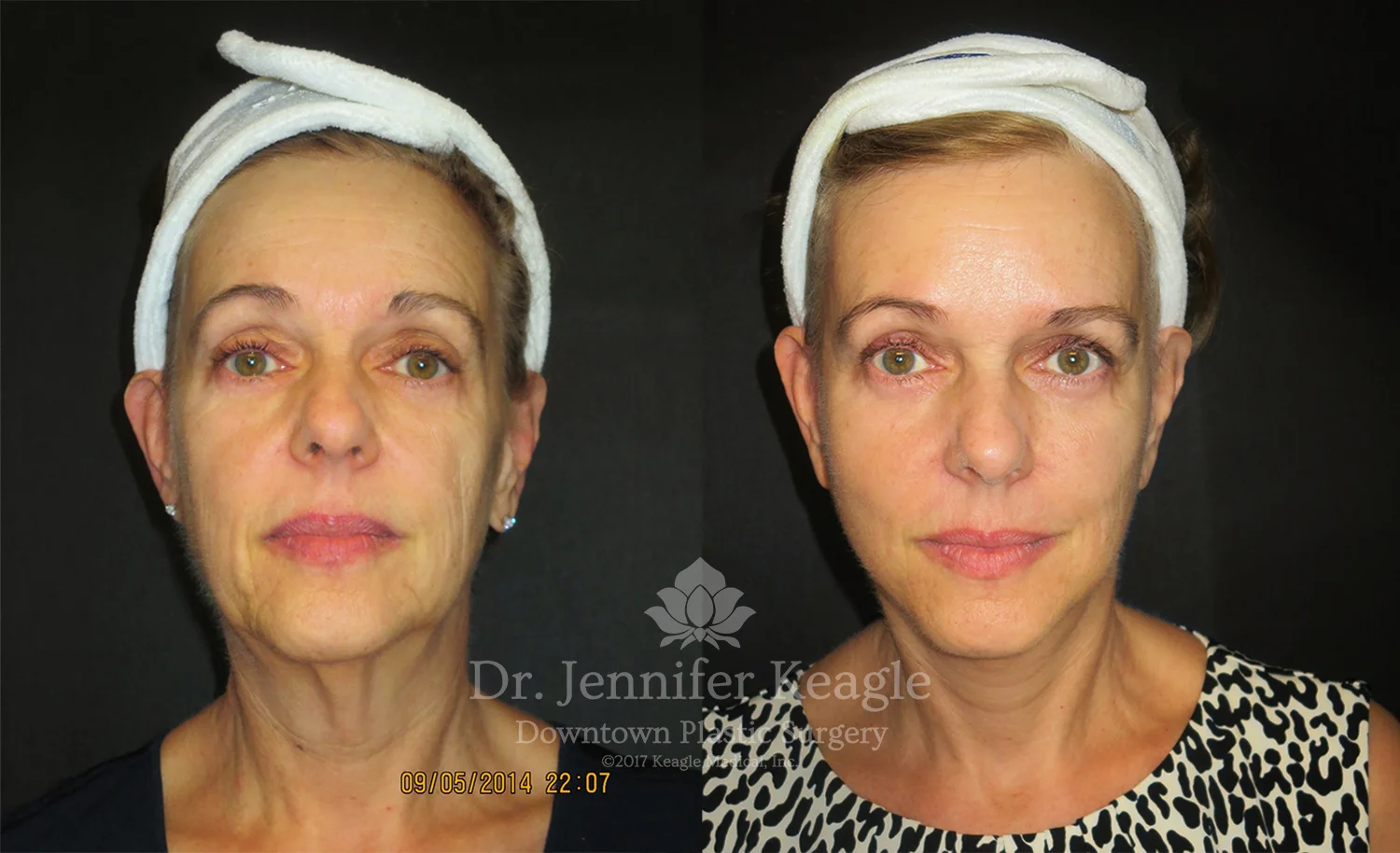 Dr-Jennifer-Keagle-Downtown-LA-Plastic-Surgery-IMG_8954