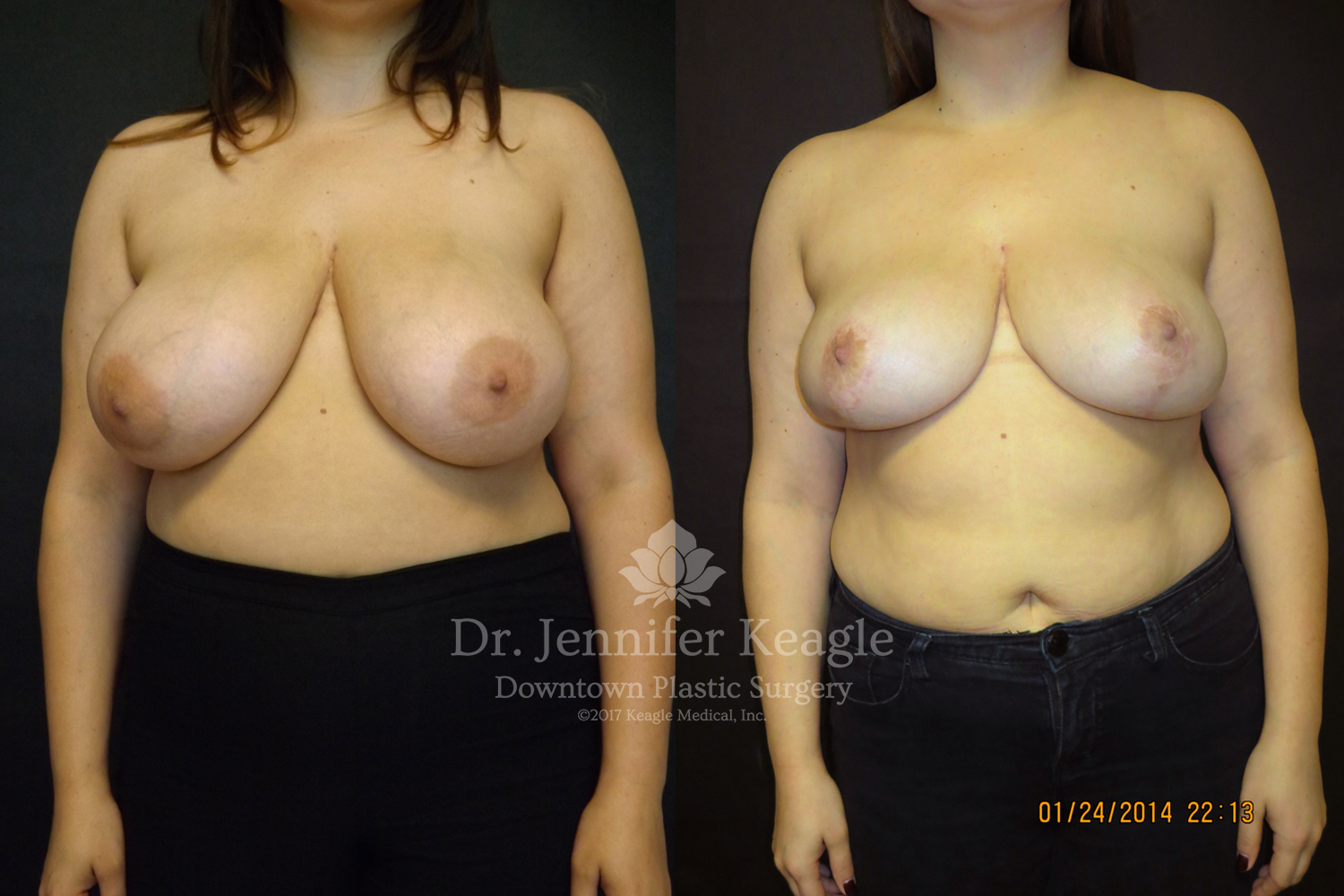 Dr-Jennifer-Keagle-Downtown-LA-Plastic-Surgery-IMG_8954