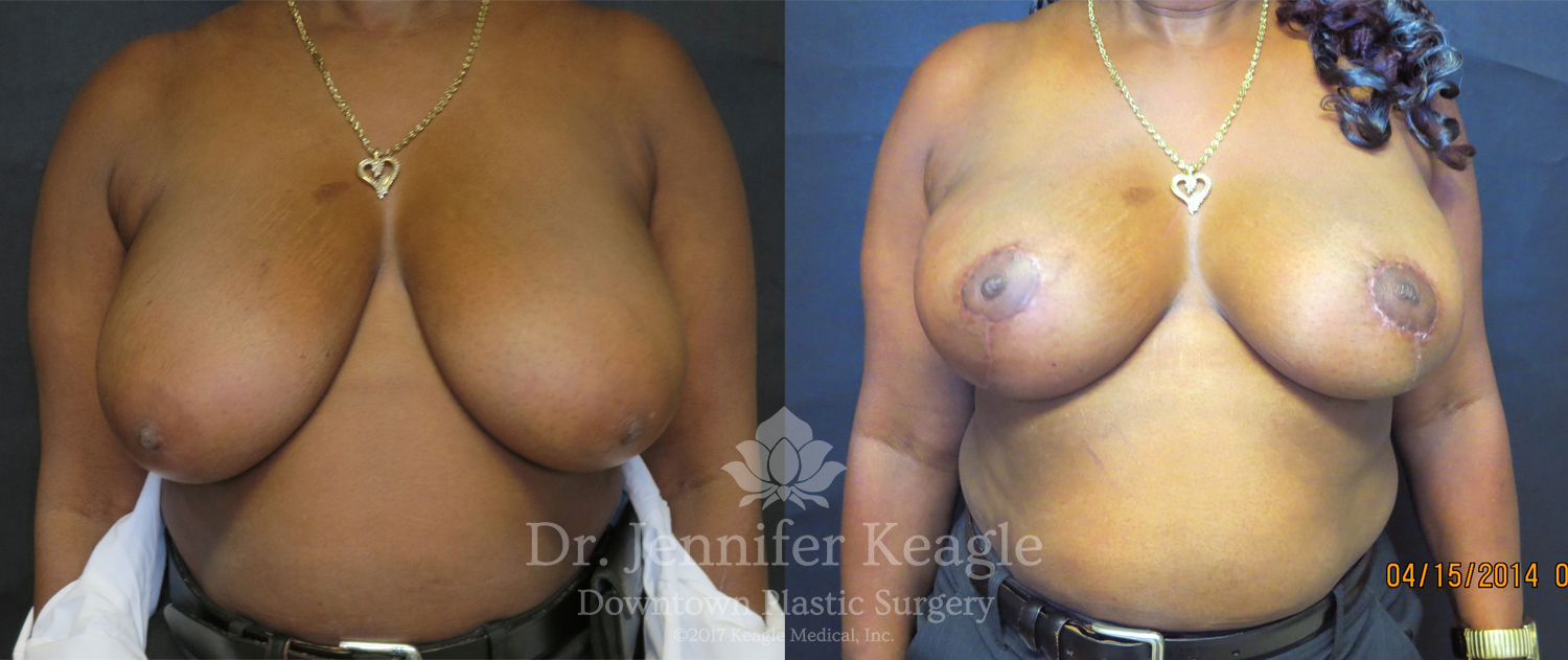 Dr-Jennifer-Keagle-Downtown-LA-Plastic-Surgery-IMG_8954