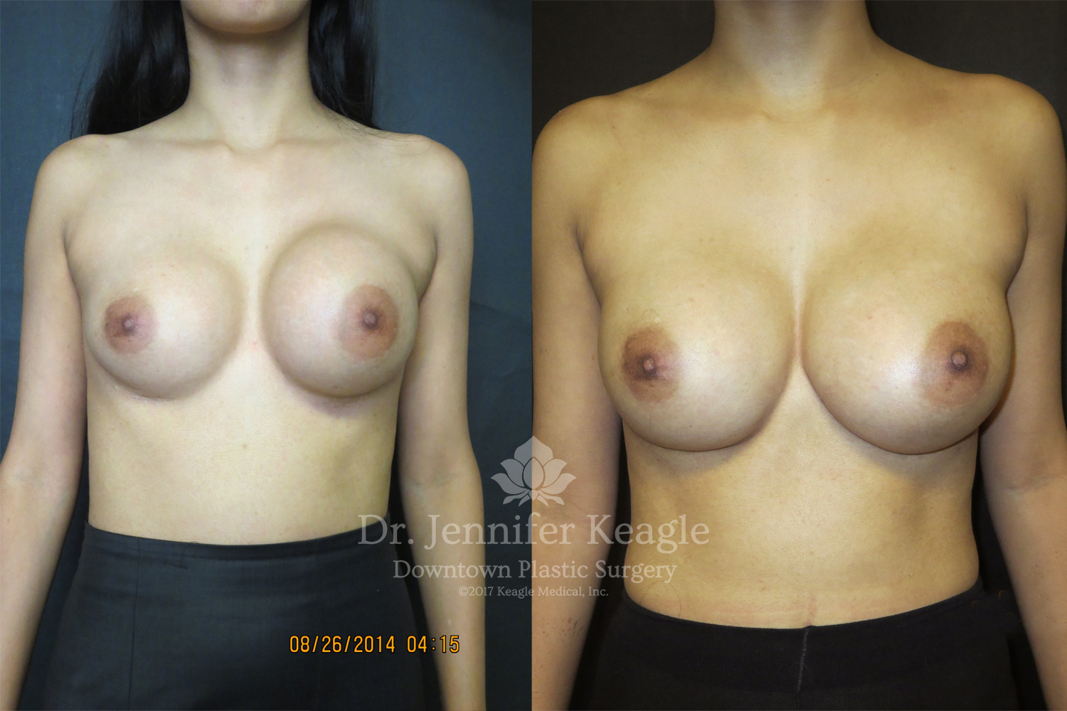 Dr-Jennifer-Keagle-Downtown-LA-Plastic-Surgery-IMG_8954
