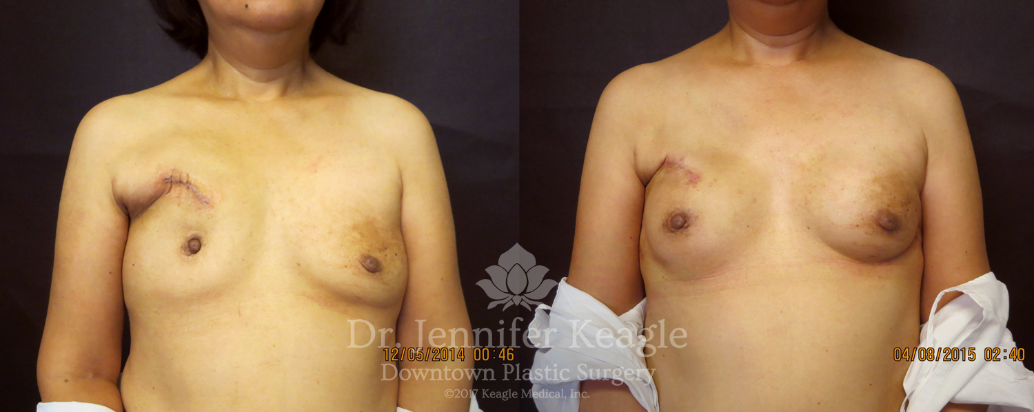 Dr-Jennifer-Keagle-Downtown-LA-Plastic-Surgery-IMG_8954
