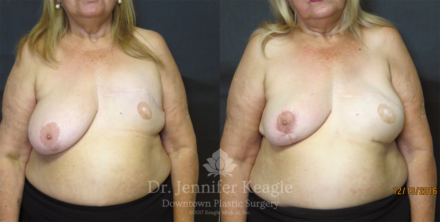 Dr-Jennifer-Keagle-Downtown-LA-Plastic-Surgery-IMG_8954