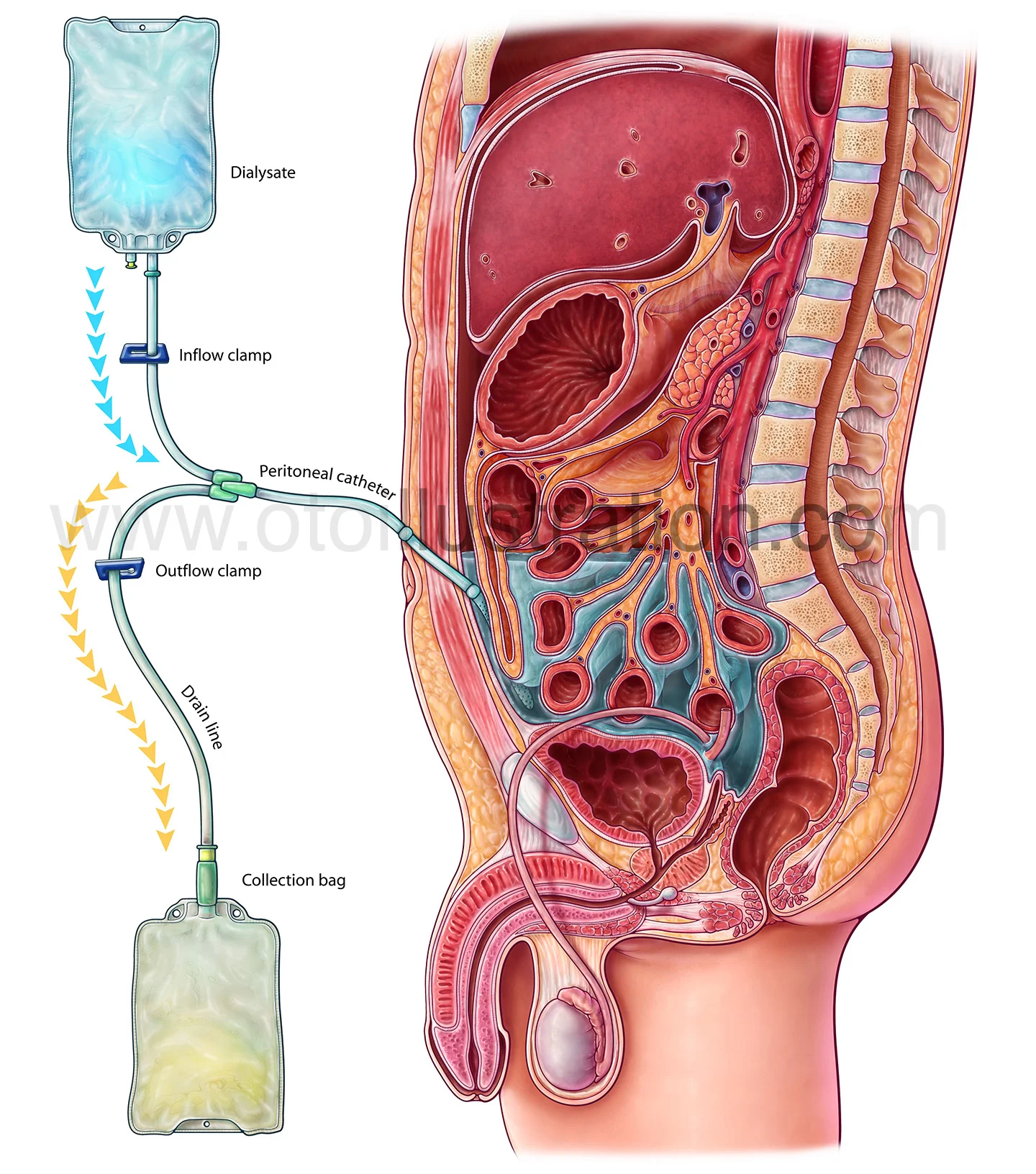 PeritonealDialysis_labeled copy.jpg