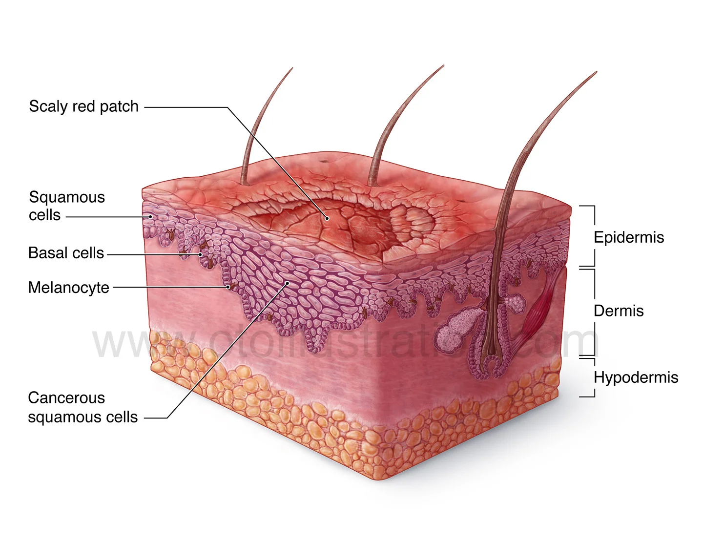 SquamousCellCarcinoma(labeled) copy.jpg