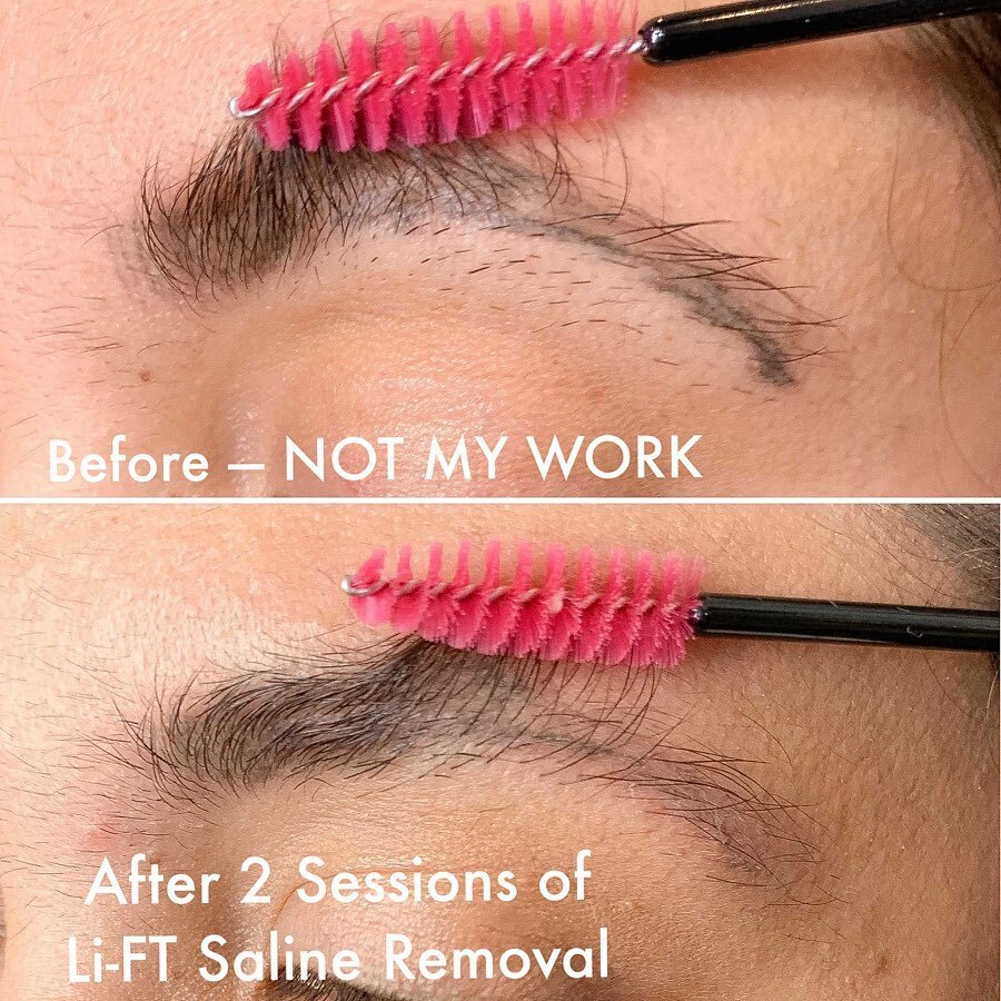 Sadly, sometimes bad brows happen to good people. (The old microblading pictured here is NOT MY WORK.) I can lighten and remove them using Li-FT, which is a saline removal formula made of all natural salt and fruit seed extract. This lovely lady righ