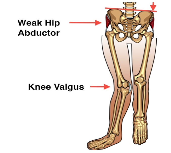 Hip abductor weakness knee valgus.png