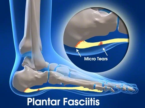 plantar fasciitis micro tears.jpg