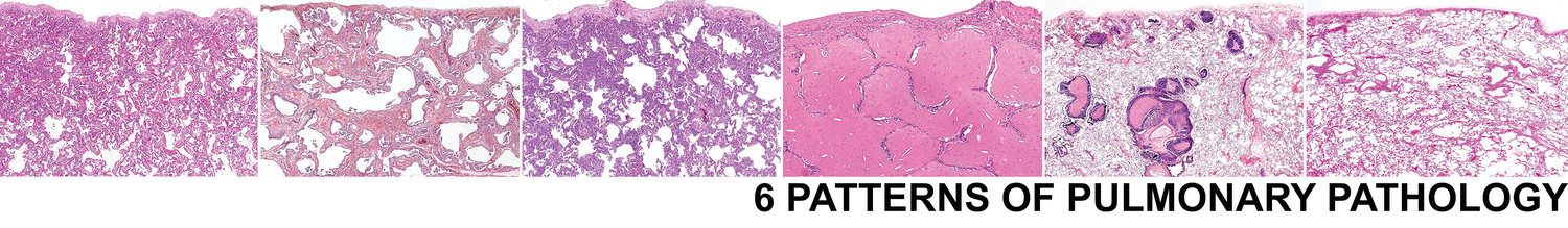 6 Patterns of Pulmonary Pathology