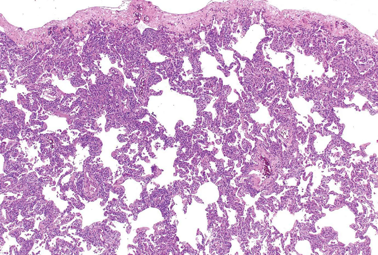 6 Patterns of Pulmonary Pathology