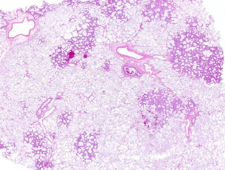 multiple nodules.jpg