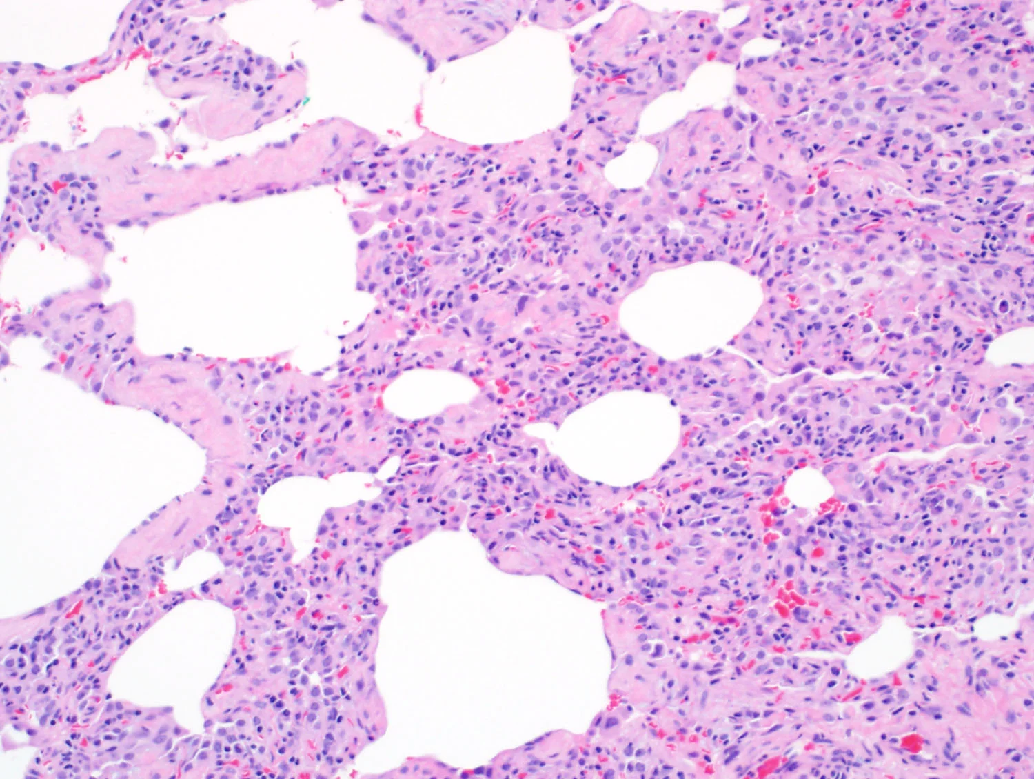 Pattern 3 - Cellular Infiltrates — 6 Patterns of Pulmonary Pathology