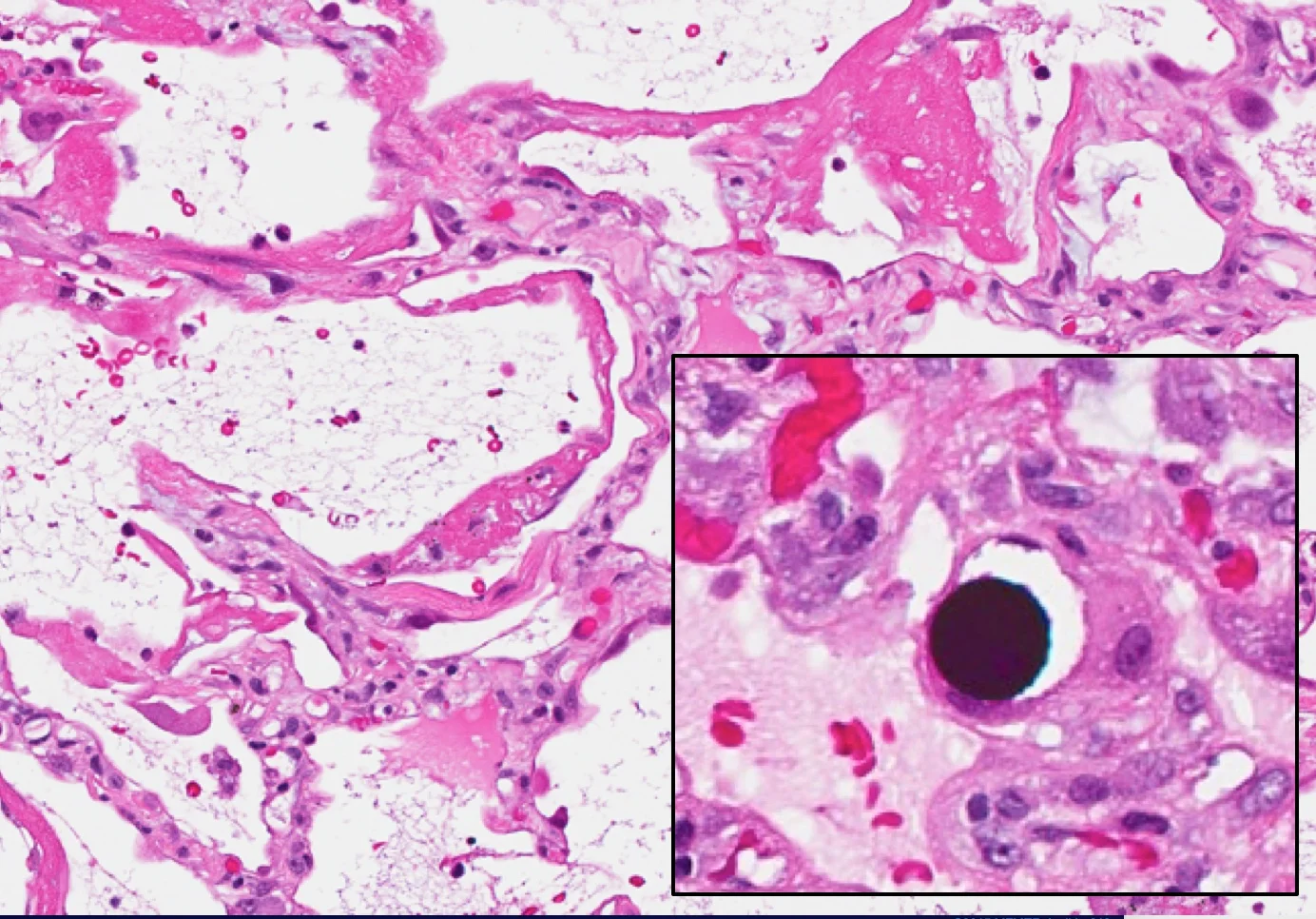 ALI w/ Hyaline Membranes — 6 Patterns of Pulmonary Pathology
