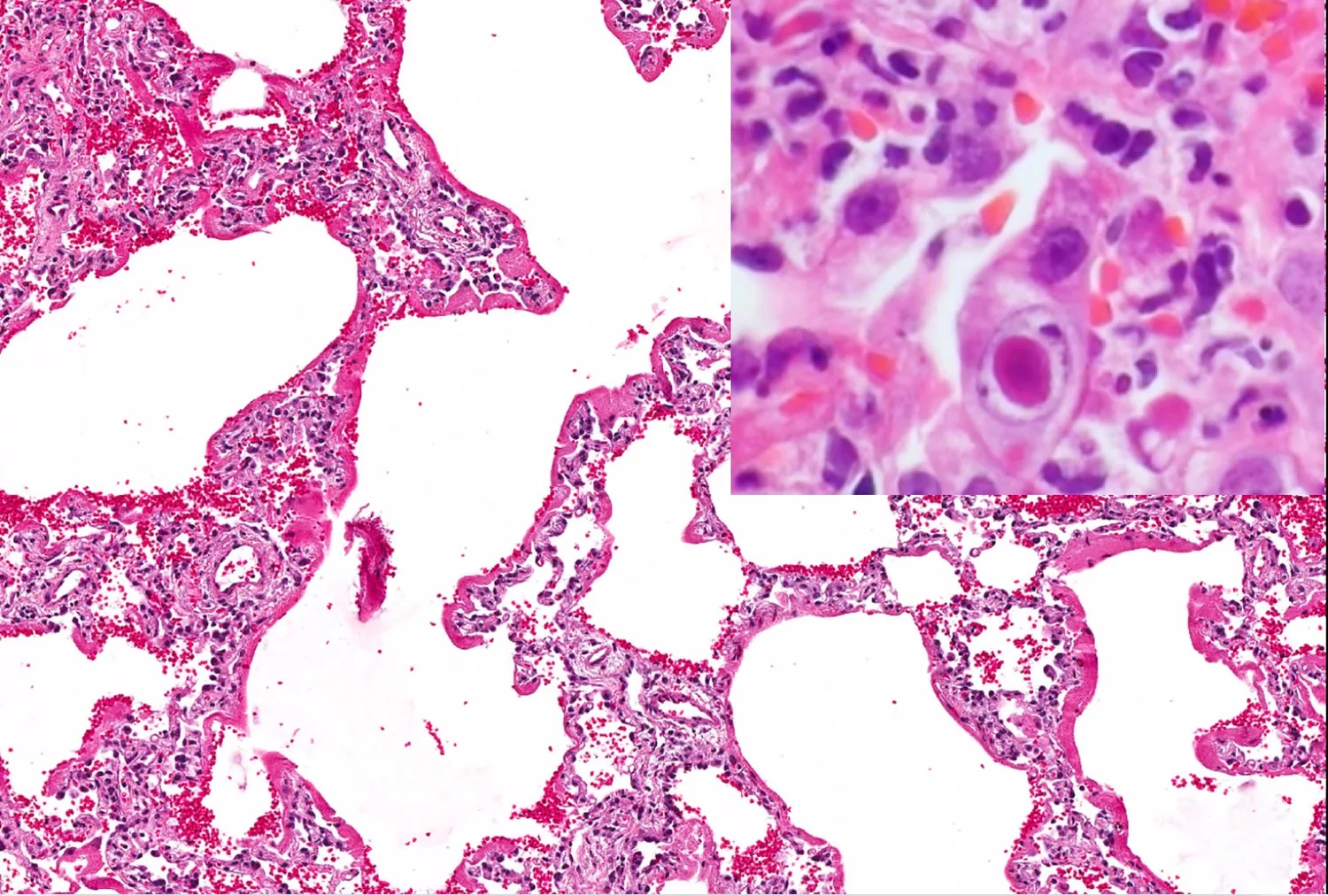 ALI w/ Hyaline Membranes — 6 Patterns of Pulmonary Pathology