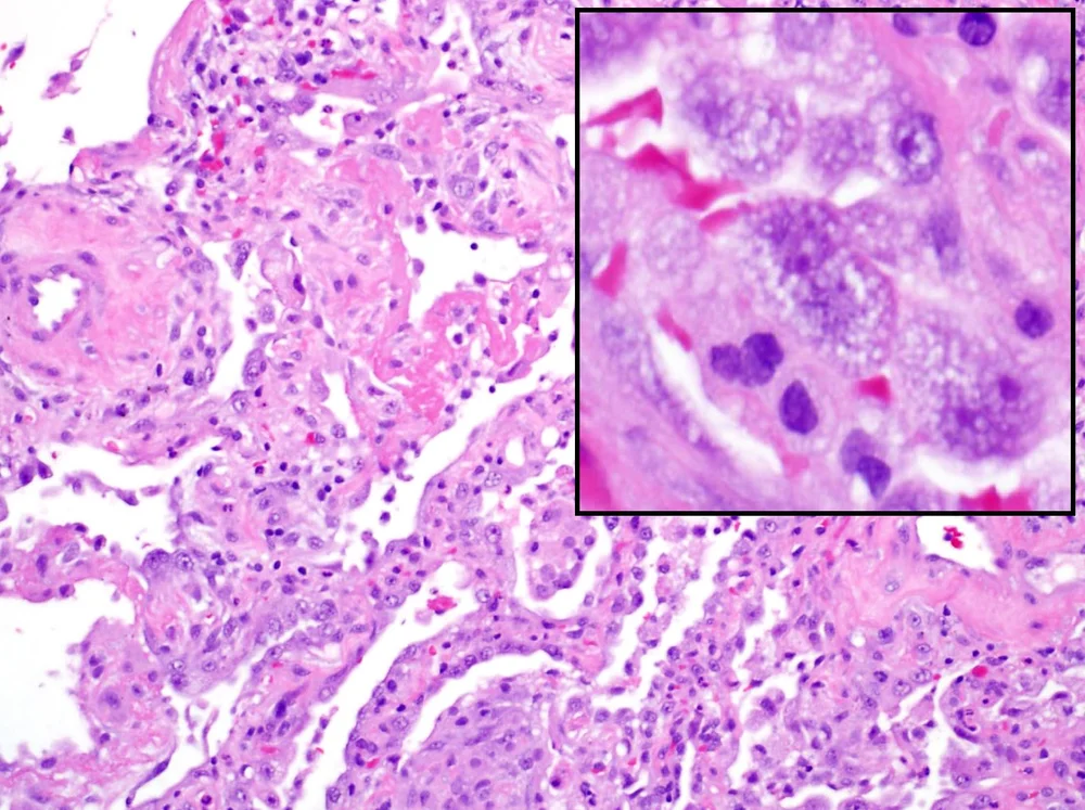 ALI w/ Hyaline Membranes — 6 Patterns of Pulmonary Pathology
