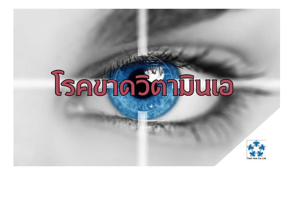วิตามินเป็นสารประกอบอินทรีย์ซึ่งเป็นสารอาหารสำคัญที่สิ่งมีชีวิตต้องการในปริมาณเล็กน้อย มีหน้าที่ช่วยการทำงานของระบบต่างๆ ในร่างกาย การขาดวิตามินอาจเป็นสาเหตุของโรคต่างๆได้มากมาย ในสมัยโบราณมนุษย์รู้จักวิตามินในแง่ของอาหารที่ใช้รับประทาน ชาวอียิปต์พบว่าการกินน้ำมันตับปลาจะช่วยให้หายจากอาการตาบอดกลางคืน ศัลยแพทย์ชาวสก๊อตพบว่าผลไม้พวกส้ม สามารถรักษาอาการลักปิดลักเปิดหรือโรคเลือดออกตามไรฟันได้ แพทย์ชาวดัตช์สังเกตพบว่าไก่ที่กินข้าวที่ไม่ขัดขาวจะไม่มีอาการเหน็บชา วิตามินช่วยขับเคลื่อนให้ร่างกายทำงานได้ตามปกติ เมื่อเราบริโภคอาหารซึ่งมีวิตามินเป็นส่วนประกอบ อาหารจะถูกดูดซึมเข้าสู่ร่างกายและถูกนำไปใช้เสริมสร้างและซ่อมแซมส่วนที่สึกหรอ วิตามินซึ่งได้จากอาหาร และดูดซึมเข้าไปอยู่ในเลือด จะถูกส่งไปตามอวัยวะส่วนต่างๆของร่างกายเพื่อให้อวัยวะต่างๆทำงานได้ตามปกติ นอกจากนี้วิตามินยังช่วยให้ระบบประสาทสั่งงานไปยังอวัยวะต่างๆได้เป็นอย่างดี หากการสั่งงานจากระบบประสาทใช้งานไม่ได้ การทำงานของอวัยวะต่างๆจะสูญเสียไป วิตามินเอ มีความสำคัญอย่างยิ่งต่อสุขภาพ โดยมีบทบาทสำคัญต่อระบบการมองเห็น การเจริญเติบโต การสร้างภูมิคุ้มกันโรค รวมทั้งการเปลี่ยนแปลงของเซลล์เยื่อบุผิวต่างๆแหล่งอาหารที่มีวิตามินเอสูงได้แก่ ตับ ไข่แดง นม เนื้อสัตว์ ผักใบเขียวเข้ม ผักและผลไม้สีเหลือง วิตามินเอ ถือได้ว่าเป็นวิตามินชนิดหนึ่ง ที่สามารถละลายในไขมันได้ อีกทั้งยังคงพบได้มากในน้ำมันตับปลา ตับ ไข่แดง พืชใบเขียวทุกชนิด และผลไม้สีส้ม ซึ่งสิ่งเหล่านี้ถือได้ว่าเป็นสารตั้งต้นของวิตามินเอโดยตรง โดยเฉพาะ ตับ ถือได้ว่าเป็นแหล่งสะสมของวิตามินเออย่างมากที่สุดเลยทีเดียว โรคขาดวิตามินเอ มักพบบ่อยในเด็ก สาเหตุของการขาดวิตามินเอส่วนใหญ่มาจากการขาดอาหาร โดยเฉพาะผู้ที่ไม่นิยมทานผักผลไม้ รวมถึงผู้ที่ขาดวิตามินเอโดยไม่ตั้งใจจากโรคท้องร่วงเรื้อรัง โรคตับอ่อนอักเสบ และท่อน้ำดีอุดตันร่วมด้วย และเมื่อร่างกายไม่ได้รับการเติมวิตามินเอตามที่ควรจะเป็น จึงส่งผลให้เกิดอาการ ดังนี้ 1. มองไม่เห็นในที่แสงน้อย หรือที่เรียกว่า อาการตาบอดสีในเวลากลางคืน แม้ว่าโดยธรรมชาติของคนเราจะสามารถปรับสายตาให้เข้ากับความมืดได้ แต่ในกรณีนี้จะทำให้สายตาไม่คมชัดเท่าเดิม เรียกว่า ตาฟางก็ไม่ผิด 2. เยื่อบุตาแห้ง หรืออาการตาแห้ง อาจมีเมือกเหนียวในตาหรือรอบดวงตา มีอาการระคายเคือง กรณีที่เยื่อบุตาแห้งอย่างรุนแรง จะส่งผลให้ตาขาวแห้งและมีรอยย่น ซึ่งแม้ว่าจะสามารถมองเห็นได้ตามปกติ แต่จะสุ่มเสี่ยงต่อการติดเชื้อได้ง่ายกว่าปกติเช่นกัน 3. อาการตาวุ้น พบได้หลังระยะตาแห้งไปแล้ว โดยจะมีอาการลักษณะตาขุ่น เหลว เนื่องจากดวงตาได้รับการติดเชื้อหรือติดเชื้อได้ง่ายและไวกว่าอาการตาแห้ง ควรเข้ารับการรักษาในทันที 4. โรคผิวหนัง เนื่องจากวิตามินเอมีส่วนสำคัญในการรักษาสภาพเยื่อบุผิวหนัง การขาดวิตามินเอจึงทำให้ผิวพรรณขาดความชุ่มชื้น และหยาบกร้านได้ โดยเฉพาะผิวหนังบริเวณข้อศอก ตาตุ่มและข้อต่อต่างๆ อาจนำไปสู่โรคทางผิวหนัง เช่น สิวและการติดเชื้อทางผิวหนังได้ 5. ภูมิต้านทานต่ำ การขาดวิตามินเอ ทำให้เกิดโรคติดเชื้อในระบบทางเดินหายใจได้ง่าย และทำให้เกิดการอักเสบในโพรงจมูก ช่องปาก คอ และที่ต่อมน้ำลายได้ ทั้งยังส่งผลให้ติดเชื้อไวรัส ทำให้เป็นหวัดง่าย ความรุนแรงของภาวะขาดวิตามินเออาจส่งผลให้ตาบอดได้ แต่หากทราบวิธีดูแลรักษาแล้ว ควรพยายามถนอมและหมั่นบำรุงสายตาด้วยวิตามินชนิดต่างๆ โดยเฉพาะวิตามินเอ เพื่อลดความเสื่อมของสายตาที่มาก่อนอายุขัยอันควร อีกทั้งการลดพฤติกรรมติดหน้าจอ เช่น งดมองหน้าจอในที่มืด ลดความสว่างหน้าจอ ไม่จดจ่อกับหน้าจอนานเกิน 8 ชั่วโมง โรคนี้เป็นโรคที่สามารถป้องกันได้ด้วยการกินอาหารที่มีวิตามินเอสูง เช่น เนื้อ ตับ ไข่ นม ฟักทอง มะเขือเทศ มะละกอสุก ผักใบเขียว พริก เป็นประจำเพื่อป้องกันไม่ให้เกิดโรคนี้ซึ่งอาจทำให้ตาบอดได้