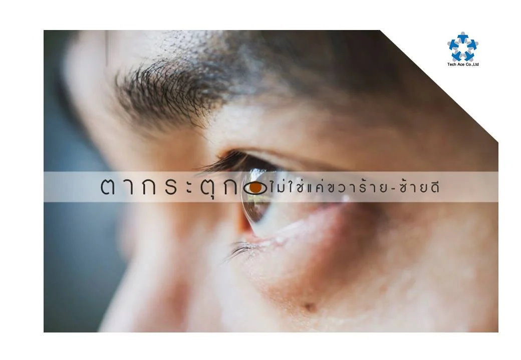 เคยมีอาการแบบนี้ไหม? วันไหนอยู่ดีๆ แล้วเกิดตากระตุกขึ้นมา คนที่มีความเชื่อตามแบบโบร่ำโบราณจะต้อง คิดทันทีว่า "ขวาร้าย ซ้ายดี" แต่ถ้าไปถามหมอก็จะได้คำตอบว่าอาการตากระตุก แบ่ง ได้เป็น 2 กรณี คือ เปลือกตากระตุก และลูกตากระตุก เปลือกตากระตุก อาจเกิดจากนิสัยความเคยชินในวัยเด็ก เด็กบางคนสามารถกระตุก เปลือกตาและใบหน้าเป็นครั้งคราวได้ และสามารถหยุดได้ทันทีเมื่อต้องการหยุด อาการจะหายไปได้เมื่อโตขึ้น นอกจากนั้นอาจเกิดขึ้นโดยไม่ทราบสาเหตุ มักพบในคน สูงอายุตั้งแต่ 50 ปีขึ้นไป เกิดกับผู้หญิงมากกว่าผู้ชาย จะมีอาการเปลือกตา ค่อยๆบีบตัวเกร็งทีละน้อยจนกลายเป็นหลับตาแน่นมากทั้งสองตา เกิดเป็นครั้งคราว เป็นๆ กายๆ ขณะหลับจะไม่มีอาการ หากทิ้งไว้นาน ความรุนแรงและความถี่จะมากขึ้นจน กลายเป็นตาปิดตลอด ทำให้สูญเสียการมองเห็นได้ เปลือกตากระตุกอีกชนิดเกิดจากกล้ามเนื้อตาและกล้ามเนื้ออบริเวณใบหน้ากระตุก มักเกิดจากเส้นเลือดในสมองโป่งพอง หรือมีเนื้องอกกดเส้นประสาทที่มาเลี้ยงเปลือกตา จะมีอาการบีบเกร็งของกล้ามเนื้อเปลือกตาและกล้ามเนื้อใบหน้าครึ่งซีกอาการเกร็ง จะคงอยู่แม้ขณะหลับจะมีอันตรายต้องได้รับการผ่าตัด ตากระตุก เป็นอาการกระตุกของลูกตาเป็นจังหวะด้วยทิศทางและความแรงแตกต่างกันออก ไป เกิดได้หลายสาเหตุ เช่น เกิดขึ้นภายใน 2-3 เดือนแรก หลังคลอดหากลูกตากระตุกเท่าๆ กันในตาทั้งสองข้างอาจร่วมกับการมีศีรษะสั่นด้วย ผู้มีอาการหรือผู้ป่วยกลุ่มนี้มักมีปัญหาเกี่ยวกับการมองเห็น นอกจากนี้ยังพบได้จากการความล้าของกล้ามเนื้อตาทำให้ตากระตุก กลุ่มนี้ไม่มีปัญหาอะไรหายเองได้ แต่หากอาการตากระตุกเป็นอยู่นานๆ ควรต้องไปพบแพทย์ เพื่อตรวจสอบ หาสาเหตุของโรคจะได้แก้ไขอย่างถูกต้องต่อไปนะคะ