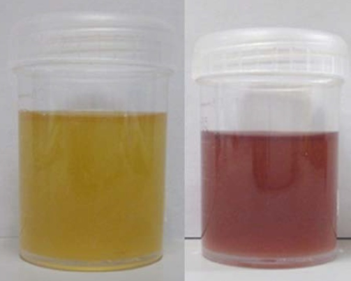 Purple urine in Porphyria (right)