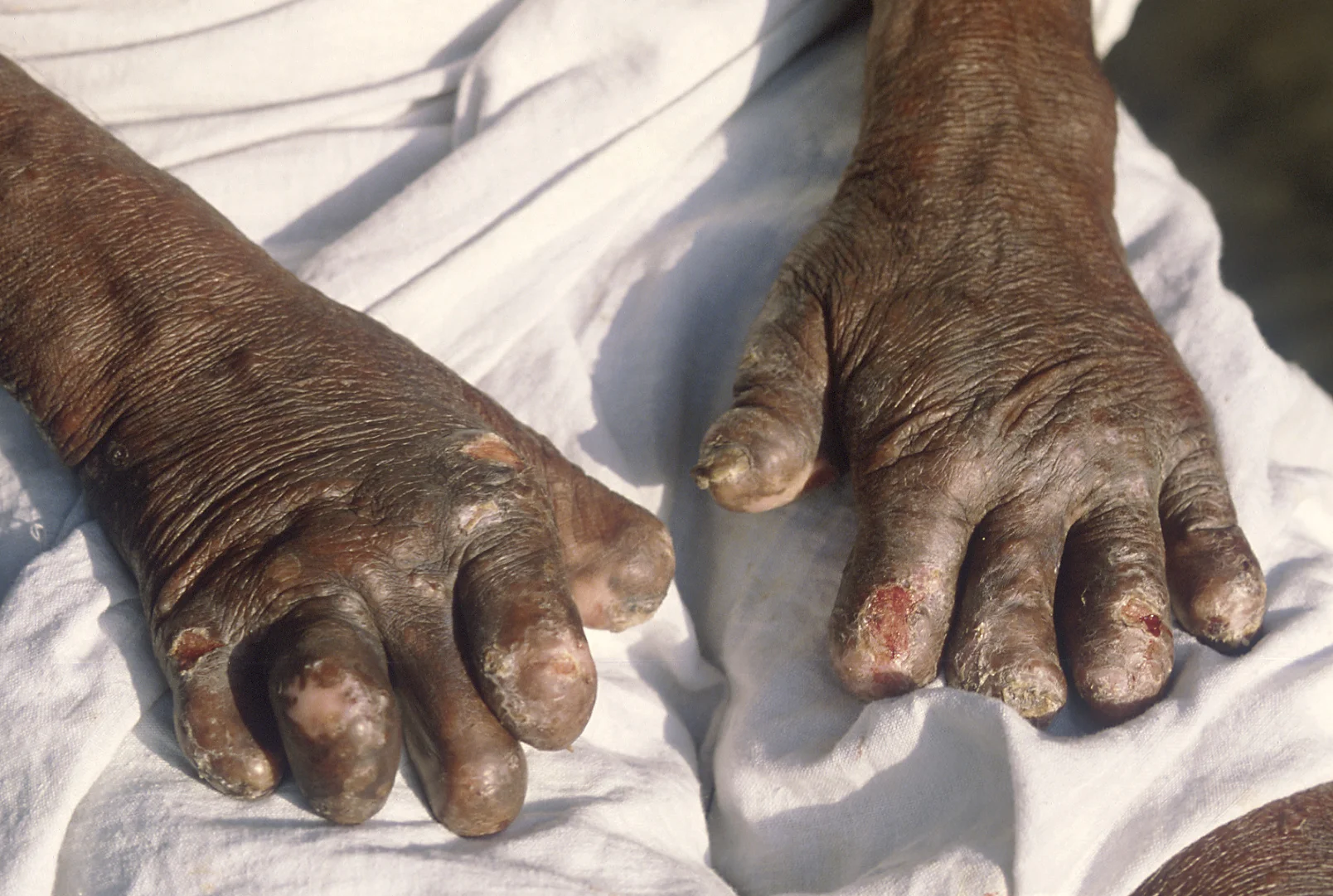 leprous hands