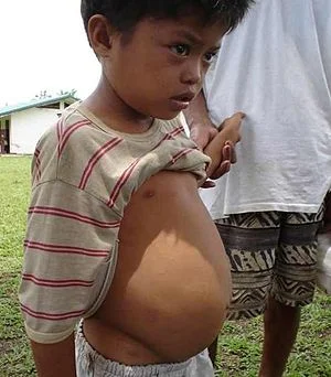 'Big Belly' in Schistosomiasis