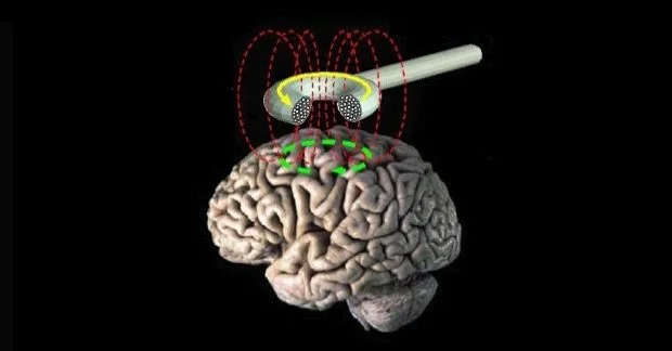 Transcranial Magnetic Stimulation