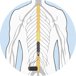 Picture illustrates the location of the epidural stimulator in the spine.