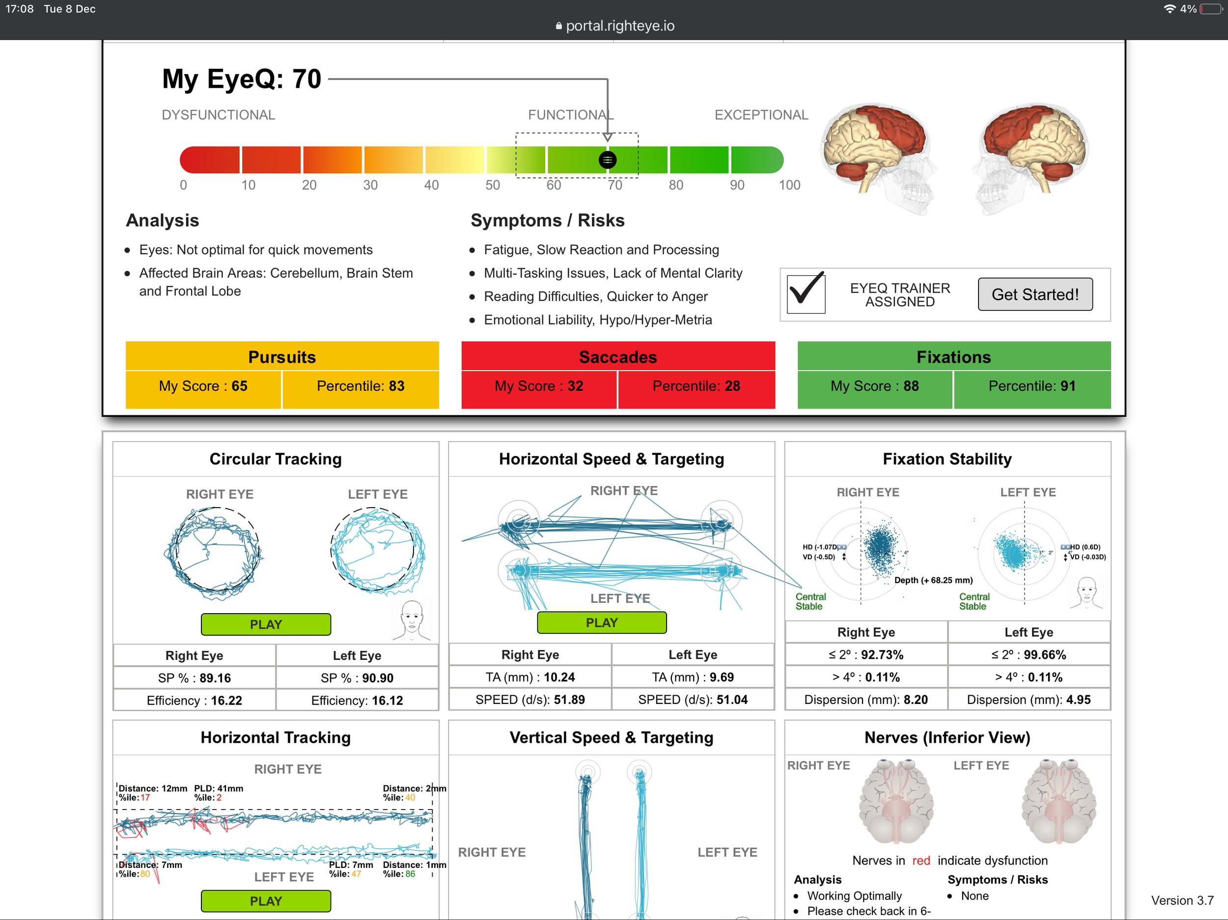 RightEye Brain Scan Results