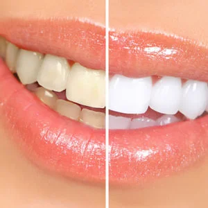 Teeth Whitening Powder Springs, GA.