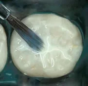Dental Sealants for Healthy Teeth