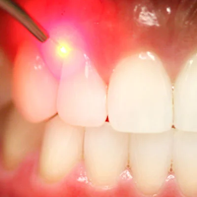 Crown Lengthening & Gummy Smile