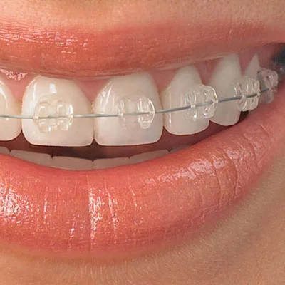 Adult Braces Six Month Smiles