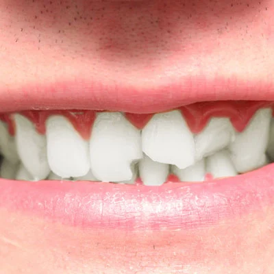 Dental Bonding Treatment Powder Springs