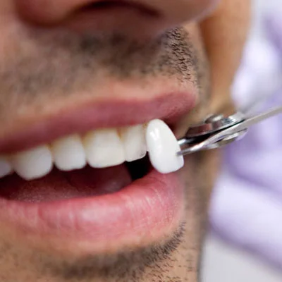 Thin Dental Veneers