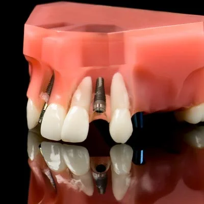 Dental Implants Restoration