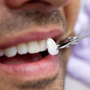 veneers-square-300x300.jpg