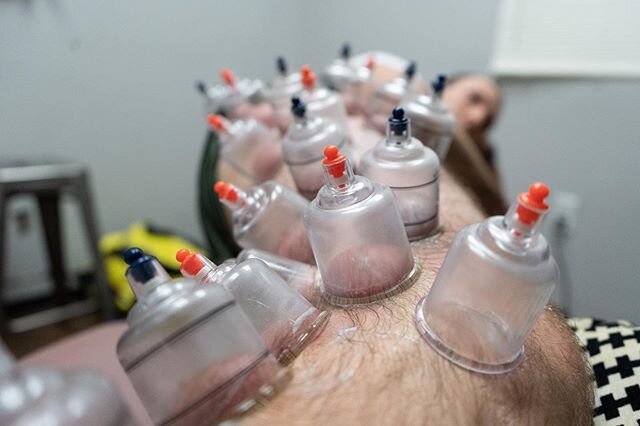 Have you ever seen circular bruises on athletes, typically on their shoulders and back? That&rsquo;s from cupping therapy!
.
.
Cupping helps increase blood flow to a specific area and also aids in reducing pain and tightness in the muscle.