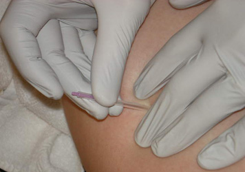 Trigger Point Dry Needling.jpg