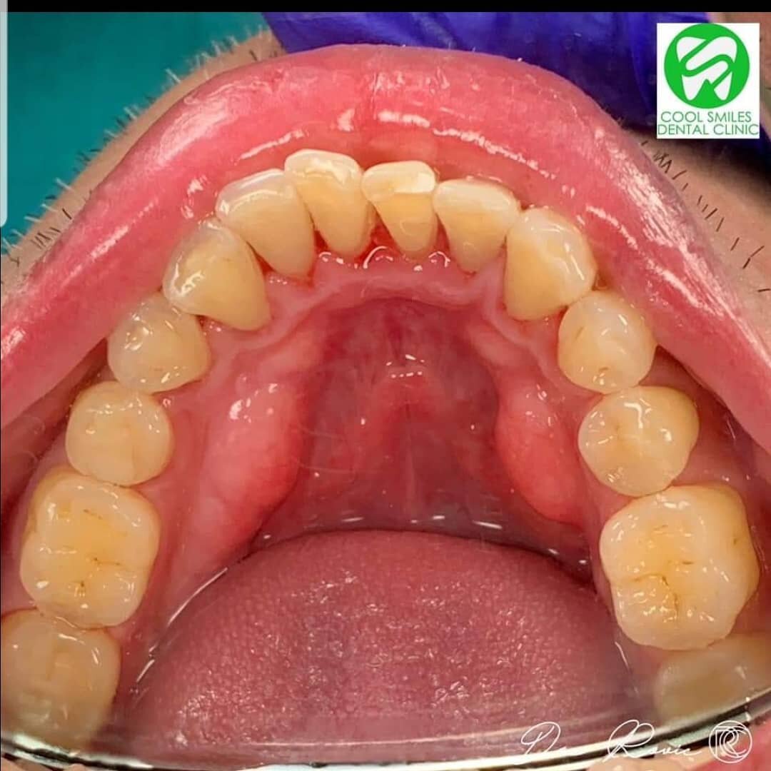 Before after scalling using Lamp.U from Philippines