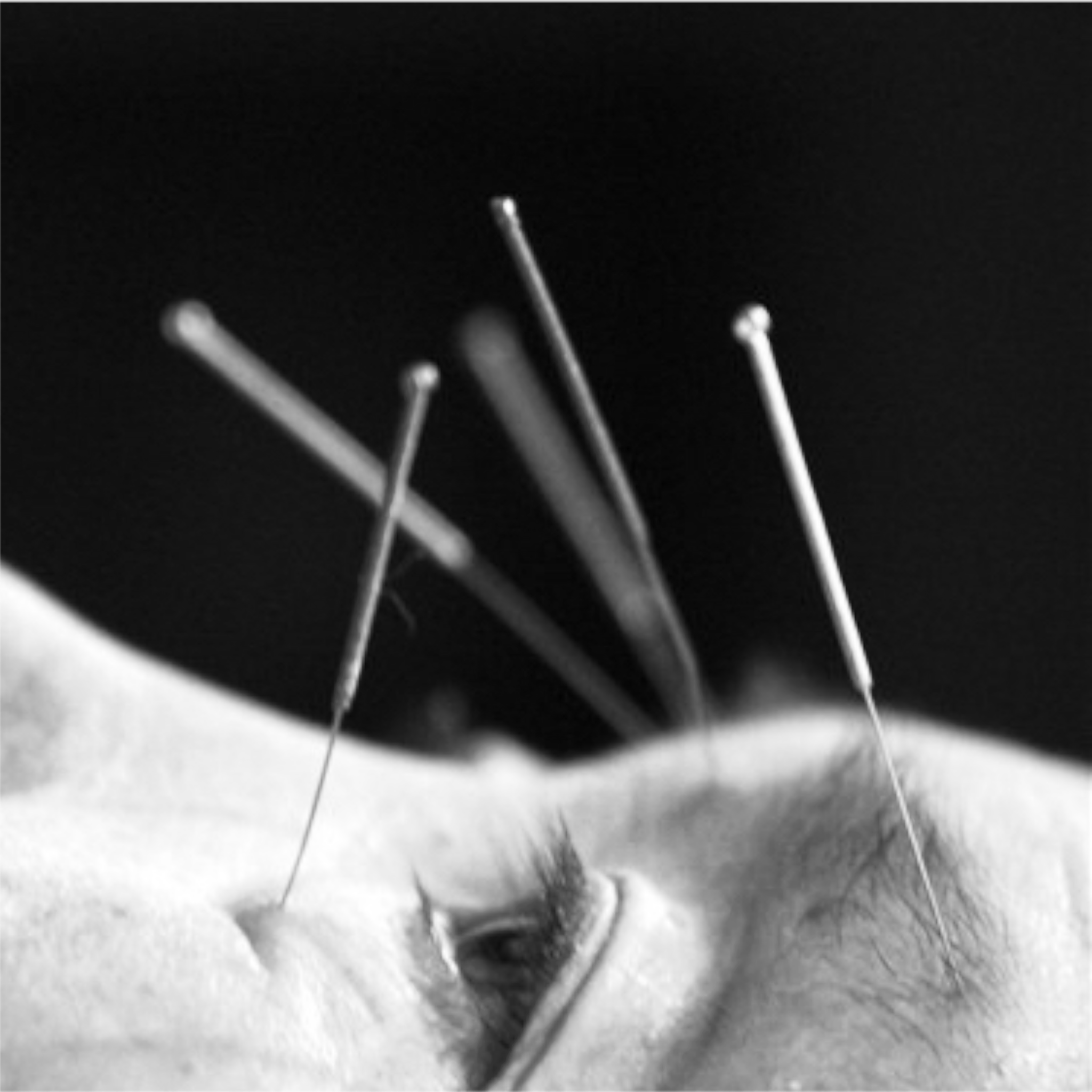TEA & PINS ~ THE DAY OF HEALING THROUGH TEA CEREMONY AND ACCUPUNCTURE