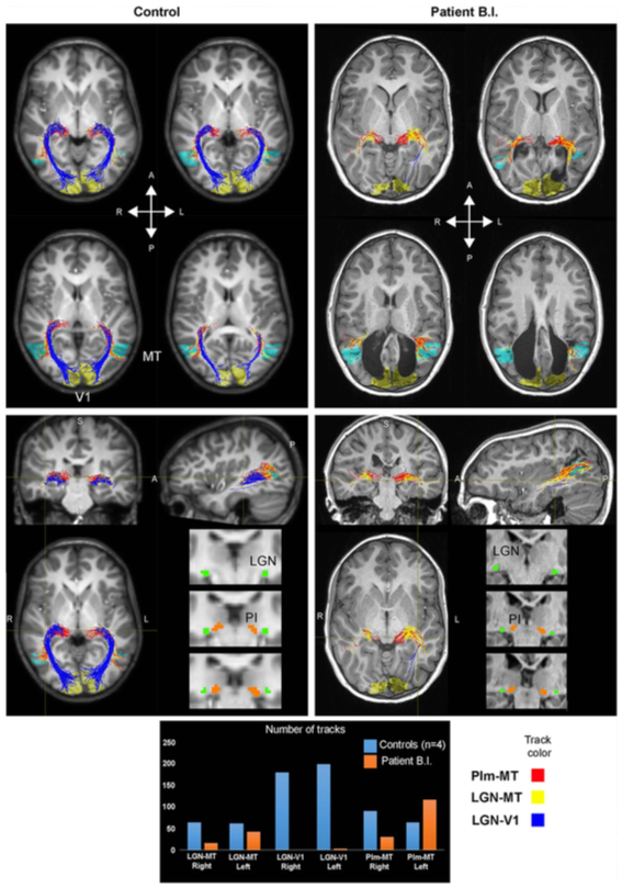 PUBLICATION IN NEUROPSYCHOLOGIA