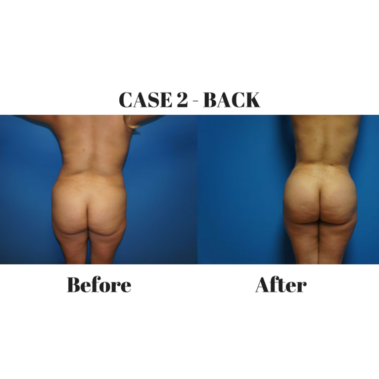 Brazilian Butt Lift Case 2 Back