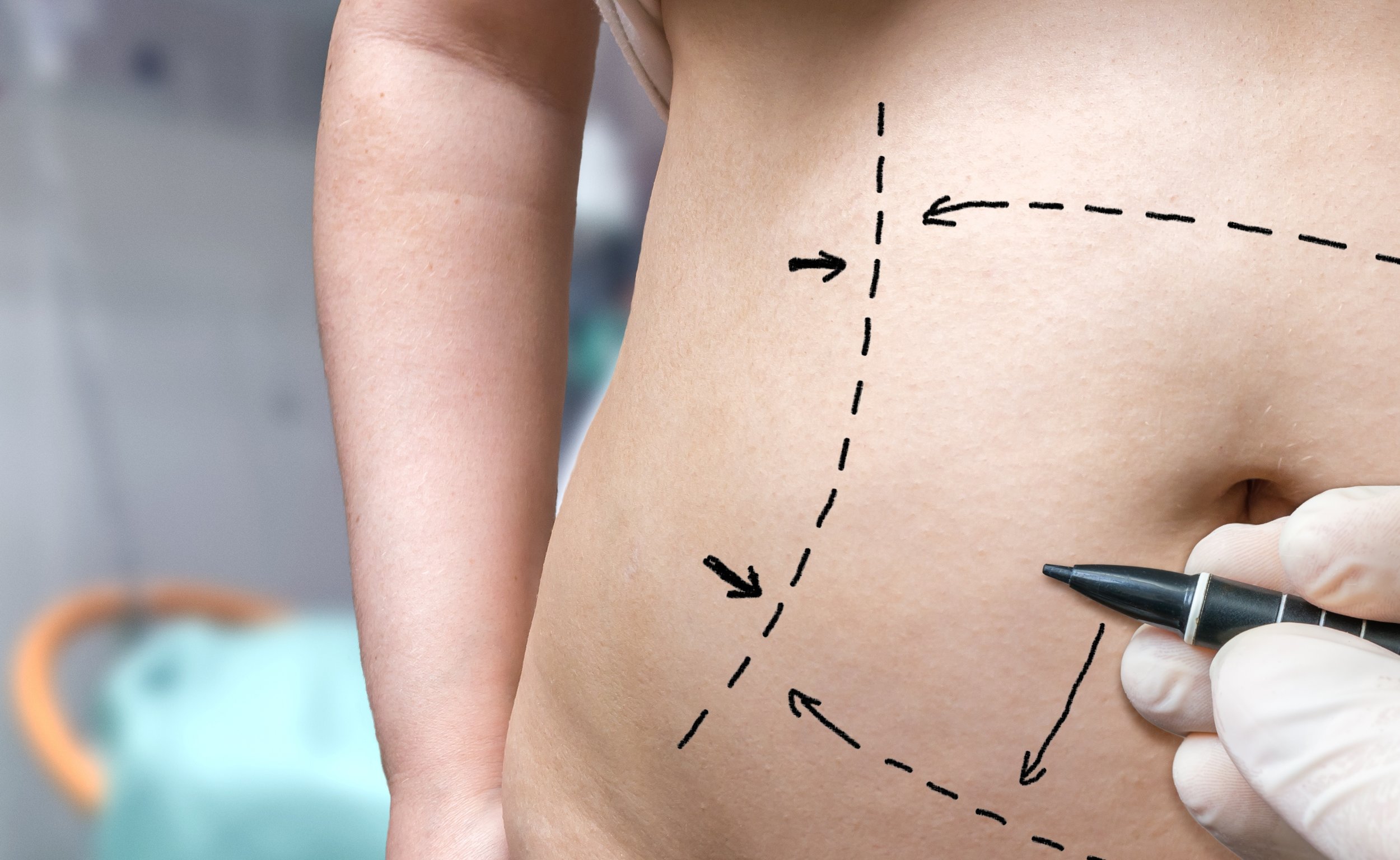 Who is a Good Candidate for Liposuction  : Criteria for Ideal Patients