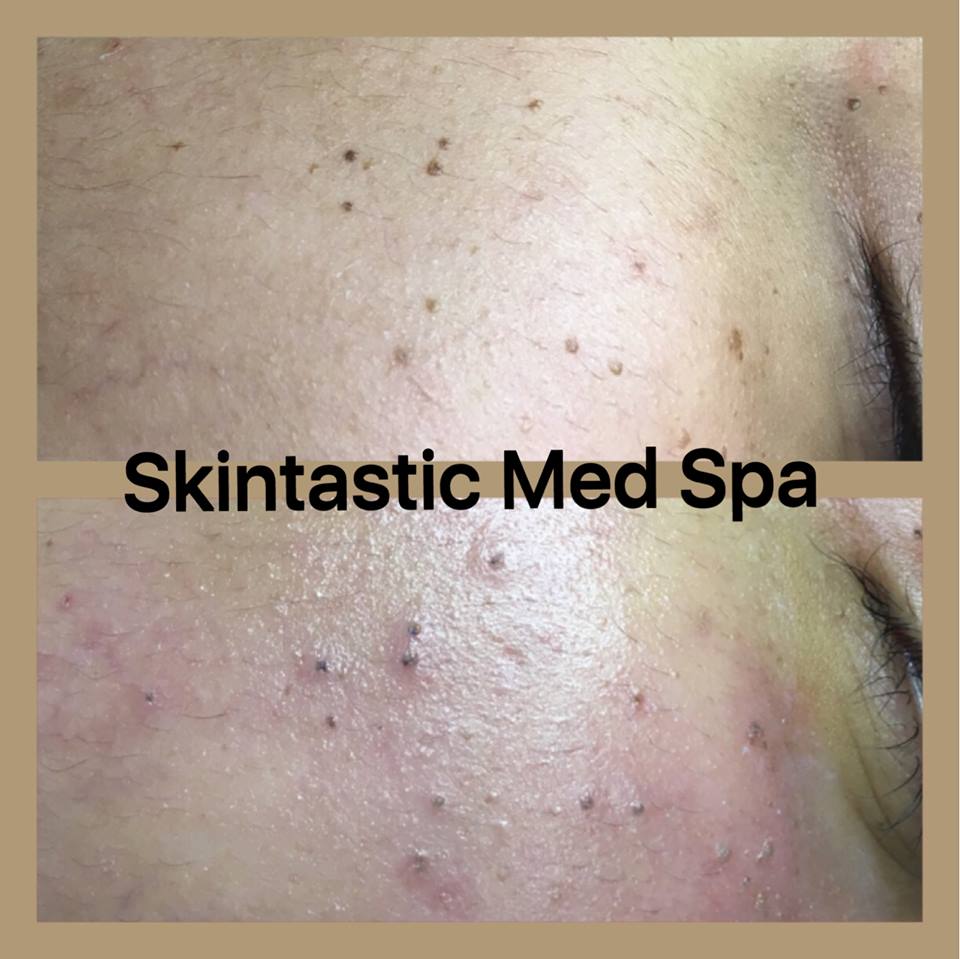 Skintastic treats a variety of skin irregularities. Call today for a free consultation to help you getting back to being comfortable in your own skin!