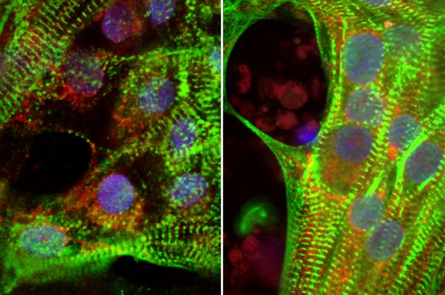 Human heart cells grown from stem cells show less-robust muscle fibers (green) in the presence of high levels of glucose (left) than when glucose levels were lower (right). (Photo: eLife/UCLA Broad Stem Cell Research Center