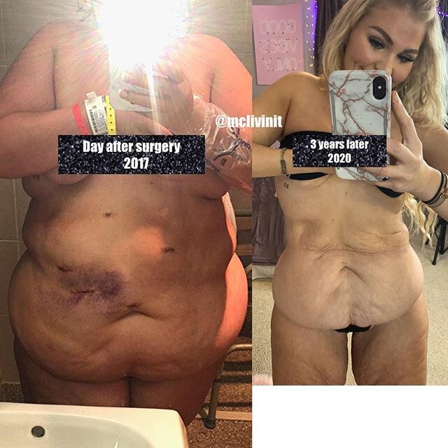 &ldquo;Isn&rsquo;t having gastric bypass the easy way out?&quot; #mclivinit #mcstory
One year ago today... 5 days after Gastric bypass surgery, I had the biggest surgery of my life. I had a life threatening blood clot the size of a deflated football,