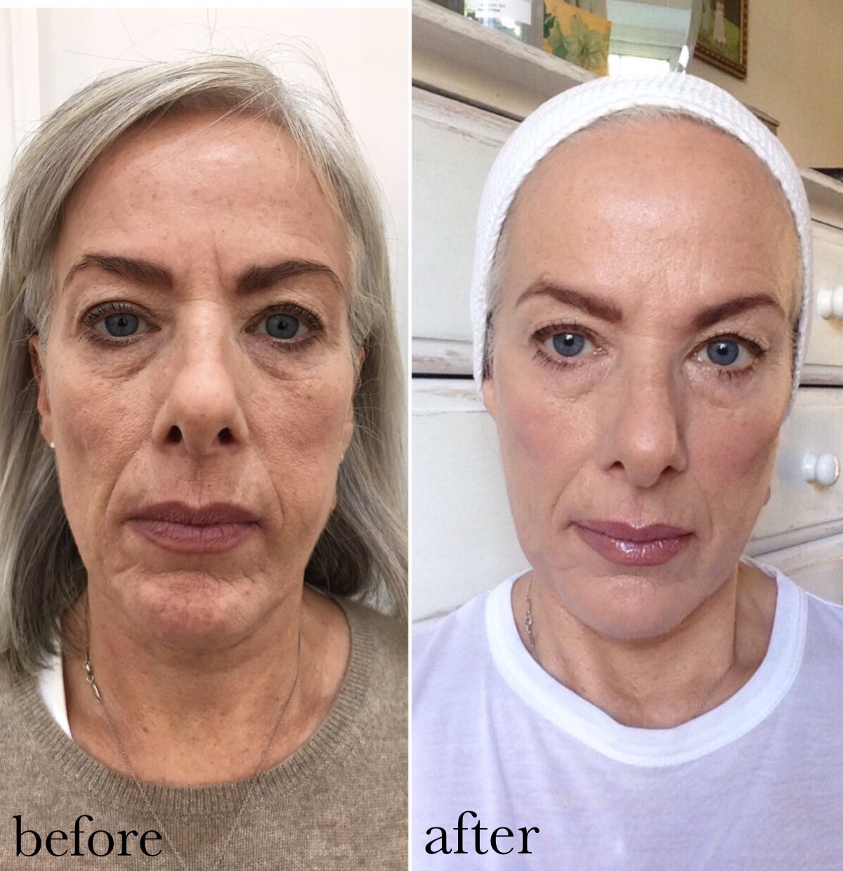PDO thread lift of the cheeks and jawline