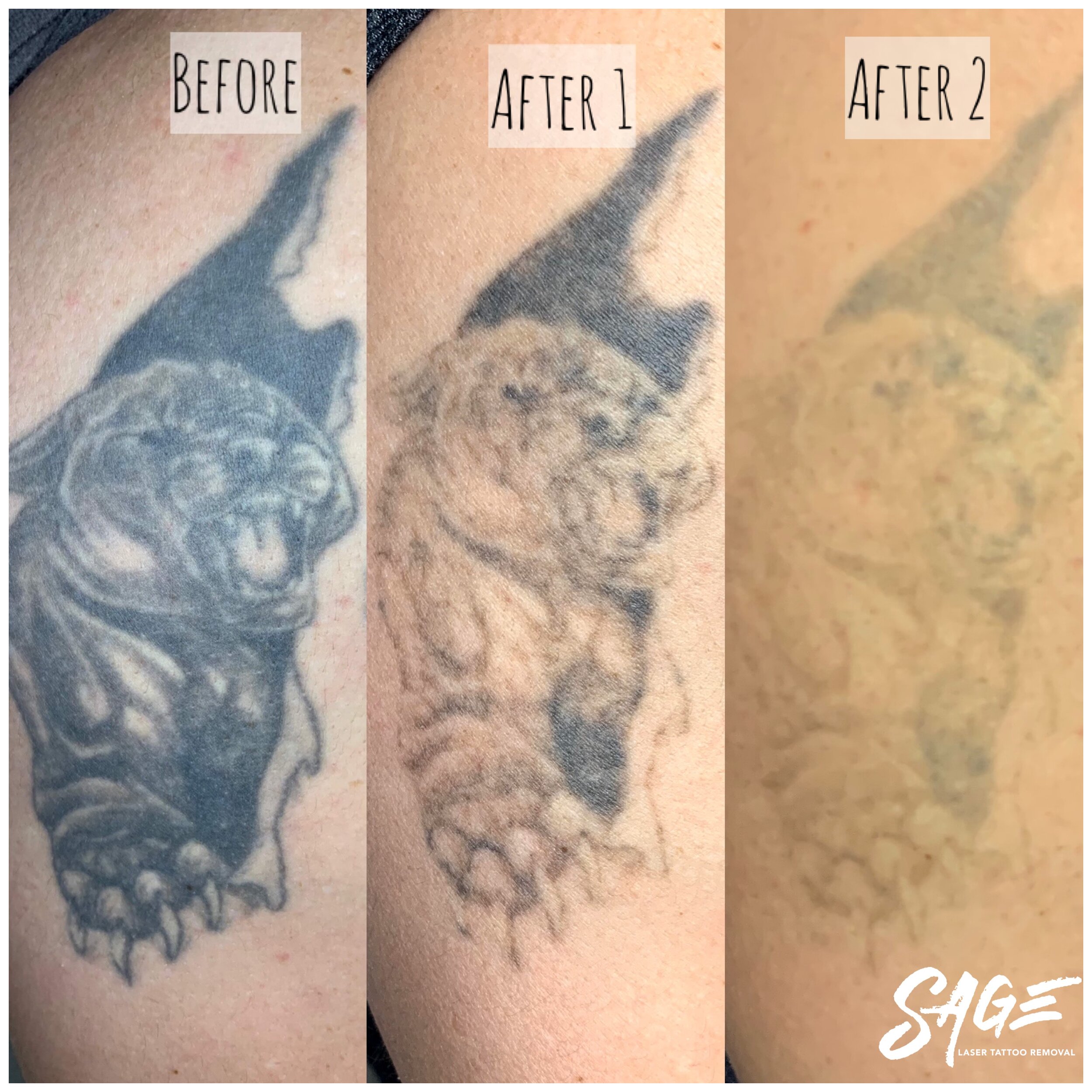 Pictures & Process — Sage Laser Tattoo Removal