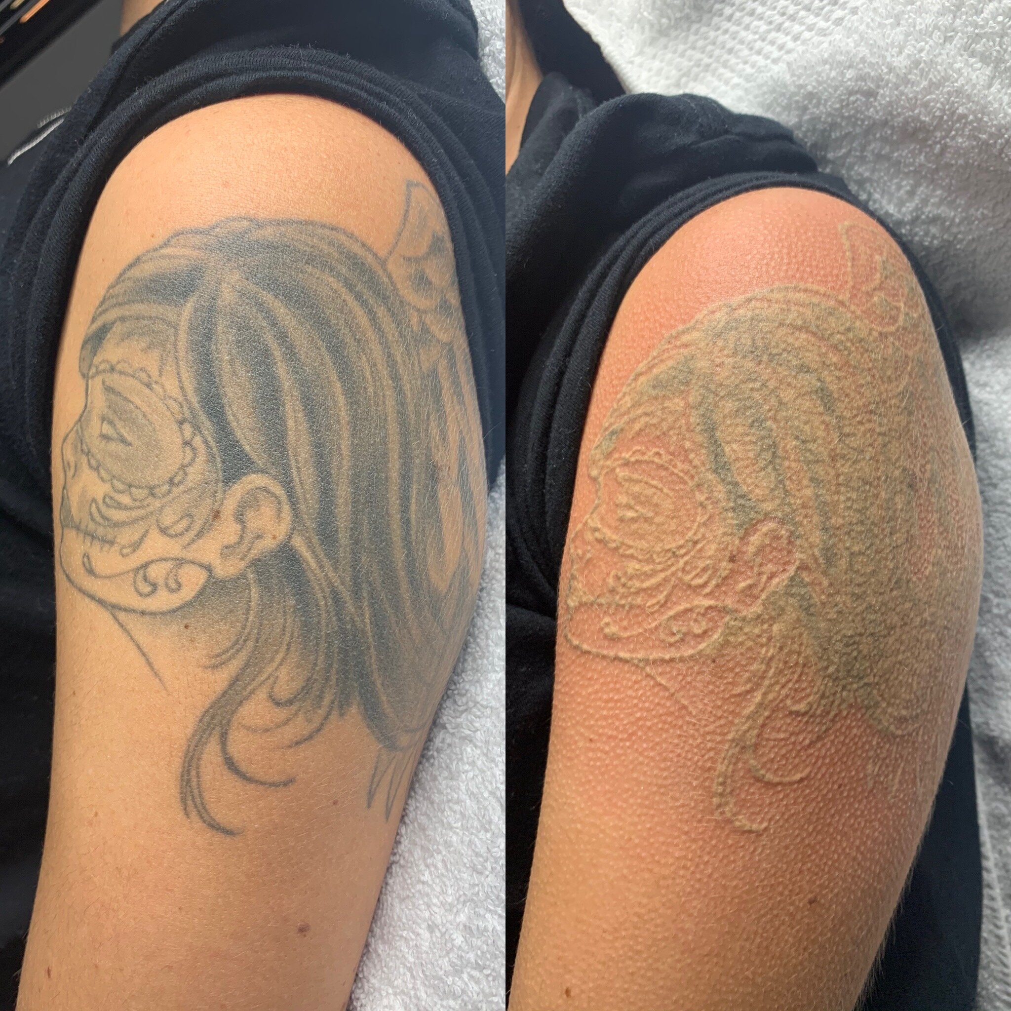 5 Laser Tattoo Removal Myths Busted  Clean Canvas Laser Clinic