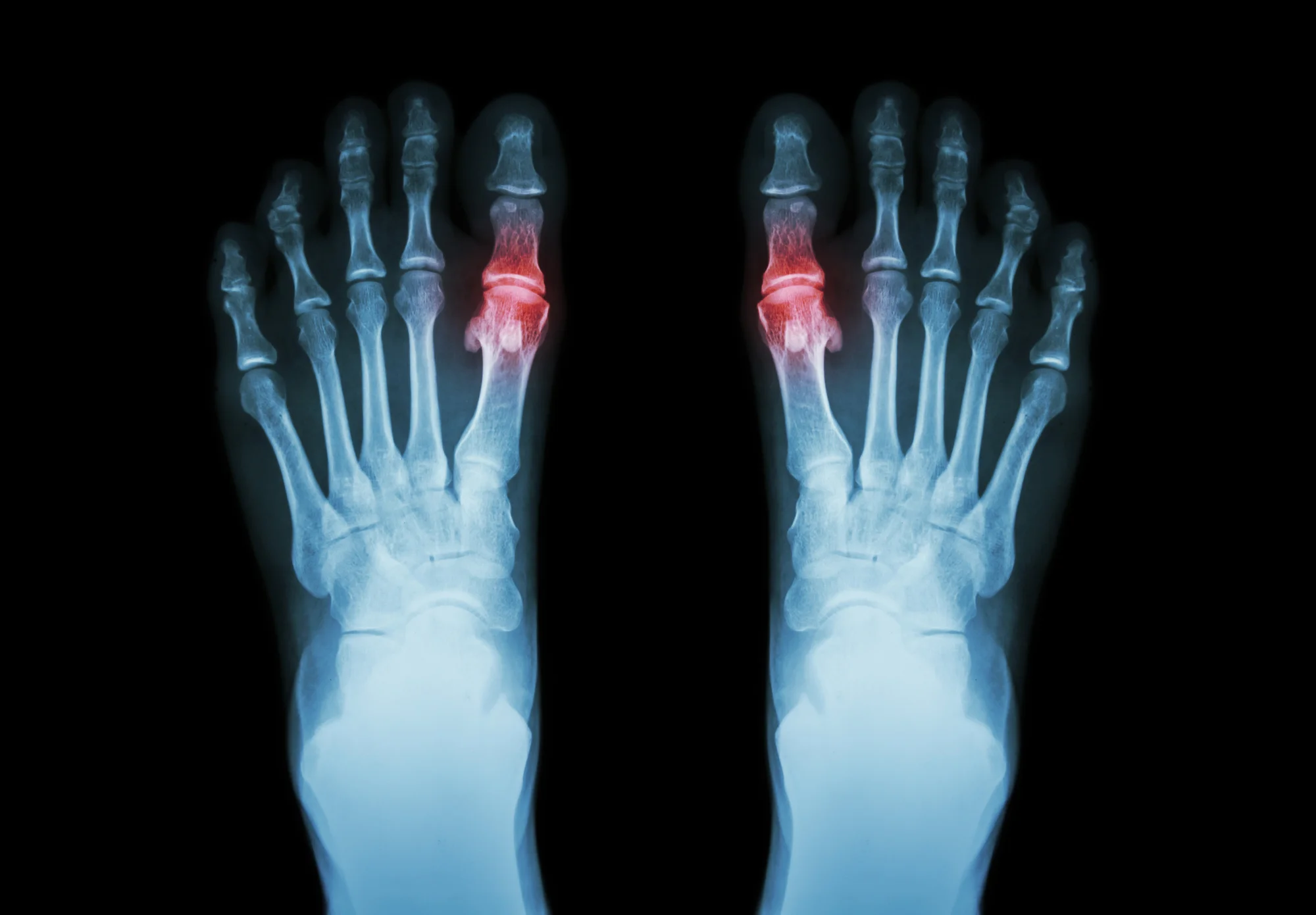 METATARSAL.jpg