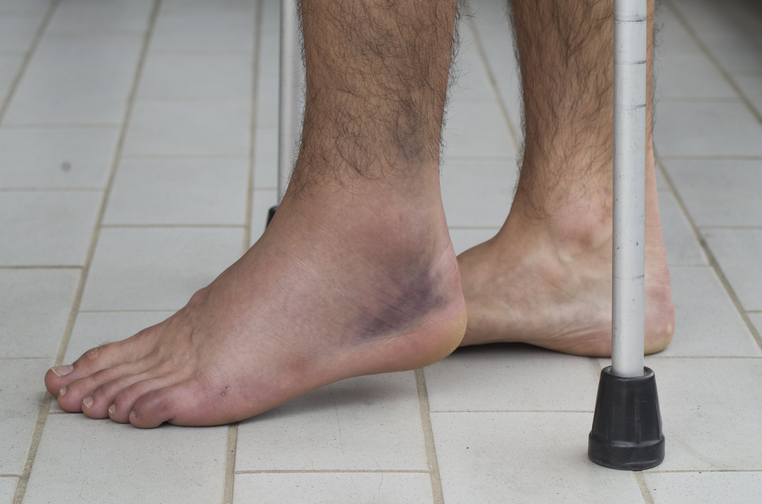 Four Sprained Ankle Symptoms — Dr. John Paul Elton